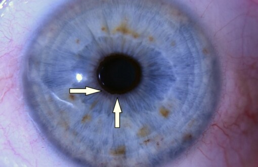 Znížené množstvo žalúdočnej kyseliny - diagnostika zo zreničky