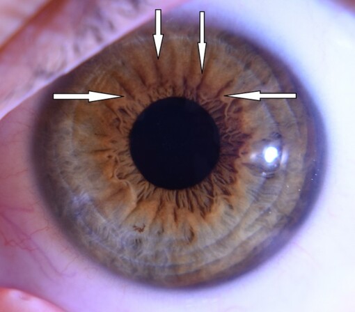 Diagnostika z dúhovky, napätia v  nervovom systéme