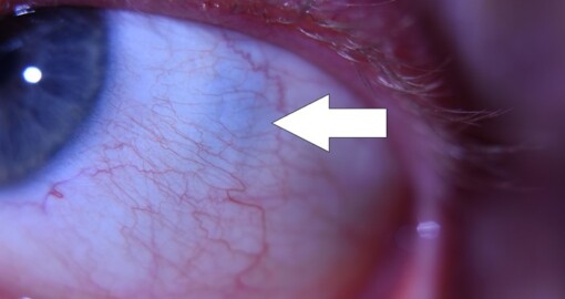 Očná diagnostika z očného bielka