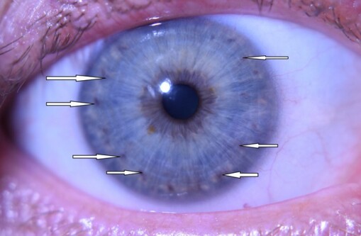 Diagnostika dúhovky
